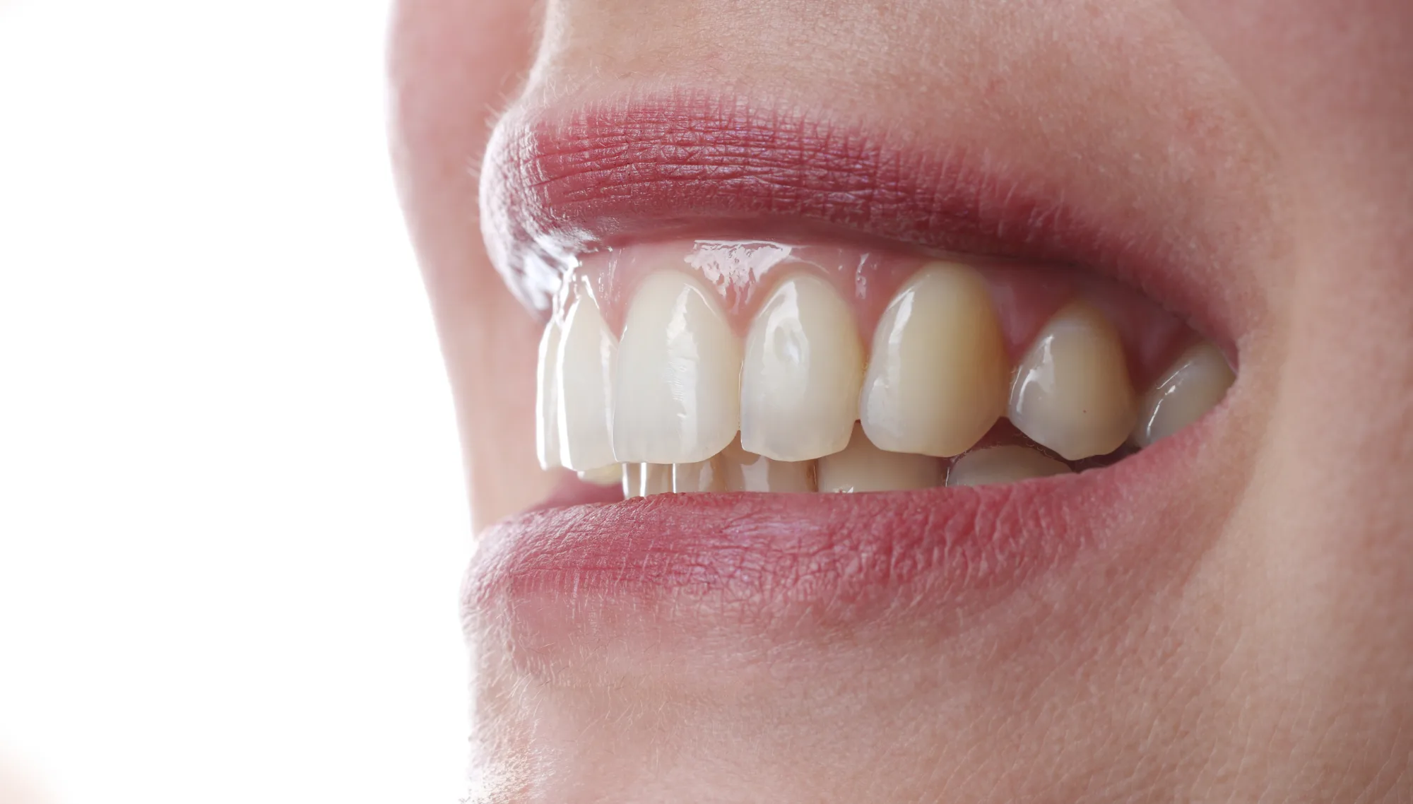 Résultat photographie dentaire — macro du sourire, translucidité des incisives